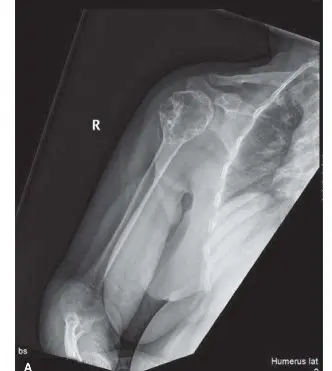 الورم الغضروفي اللانمطي أو الساركوما الغضروفية منخفضة الدرجة في الفخذ: دليل شامل للمرضى مع الأستاذ الدكتور محمد هطيف