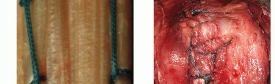 Illustration 35 for Distal Humeral Fractures: When Is Elbow Replacement the Best Option?