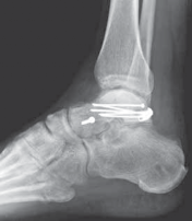 Illustration 32 for Talar Neck Fracture Treatment: Optimizing Recovery with ORIF