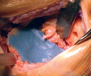 Illustration 32 for Cemented TKA Figure: Your Visual Guide to Surgical Success