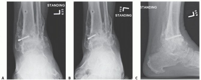 Illustration 53 for Optimize Pain Management with Proximal Ring Block for Ankle Arthrodesis