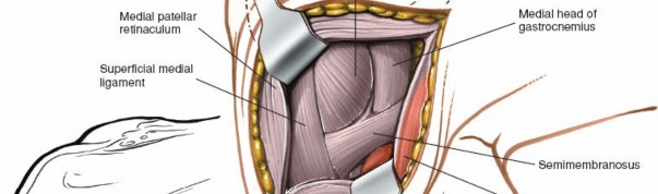 Illustration 79 for Mastering Knee Approaches: Spotlight on Superficial Medial Ligament