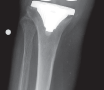 Illustration 46 for PROSTALAC Articulating Spacer: Treat Infected Knees, Regain Mobility