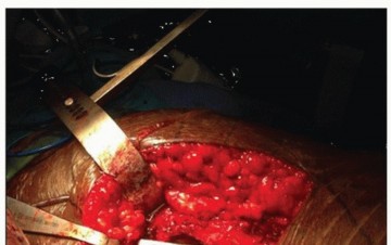 Illustration 18 for Extensively Porouscoated Stems: Proven Success & Superior Fixation