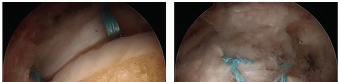 Illustration 4 for Hip Pain Relief: Arthroscopy for Nonstructural Pathology