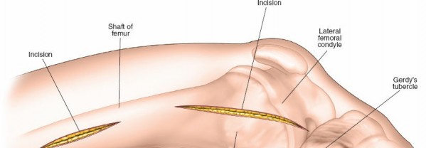 Illustration 51 for Optimal Femoral Approaches: Mastering the Lateral Intermuscular Septum