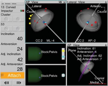 Illustration 25 for Avoiding Errors: Navigation in Total Hip Arthroplasty