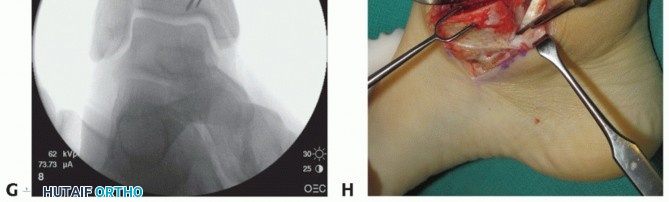 Illustration 6 for Unlock Healing: Medial Malleolar Osteotomy for Talus OLT Allografts
