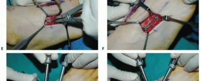 Illustration 30 for Mastering Midfoot Arthrodesis: Protect the Deep Neurovascular Bundle