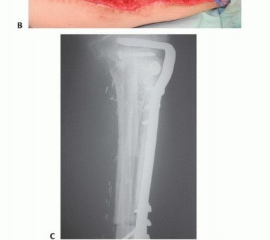 Illustration 37 for Free Vascularized Fibular Grafts: Solving Complex Bone Defects