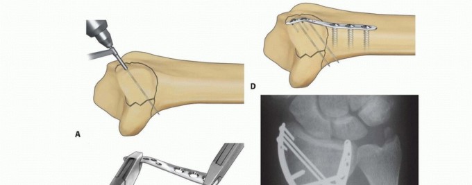 Illustration 38 for Fragment-Specific Fixation: Restore Carpal Facet Horizon