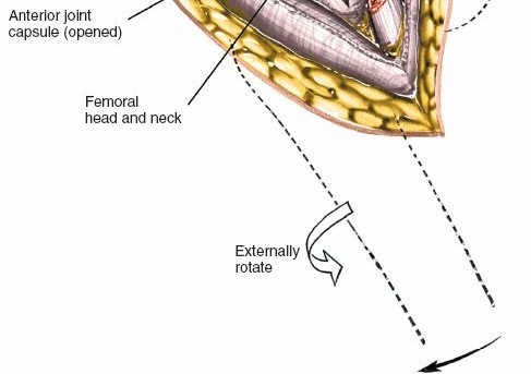 Illustration 52 for Unlocking Every Aspect of the Hip's Surgical Approaches