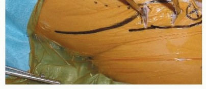 Illustration 21 for Emergency Fixation of the Pelvis: Control Bleeding & Restore Stability