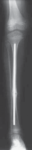 Illustration 23 for Solving Congenital Pseudarthrosis: Tibia with the Williams Rod