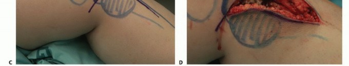 Illustration 3 for Avoid Major Surgery: Bone Tumor Treatment with Liquid Nitrogen Pour