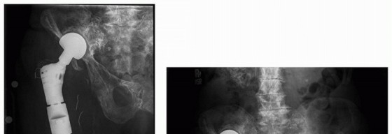 Illustration 43 for Allograft Prosthetic Composite: Mastering Proximal Femur Reconstruction