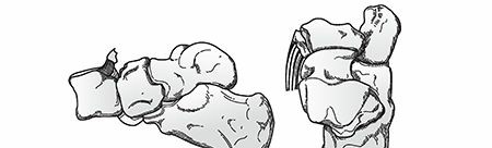 Illustration 10 for Mastering First MTP Joint & Forefoot Fractures: A Comprehensive Guide