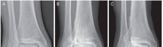 Illustration 5 for Medial Ankle Instability: Find Relief with Reconstruction