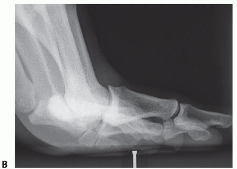 Illustration 11 for Restore Your Foot: Surgical Treatment for Hallux MP Joint Turf Toe