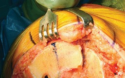 Illustration 26 for Mastering TKA: Essential Methods of Rotational Alignment