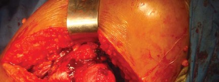 Illustration 11 for The Silent Hip: Achieving a Truly Silent, Pain-Free Joint