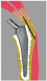 Illustration 30 for Sliding Trochanteric Osteotomy: Modern Role & Refined Techniques