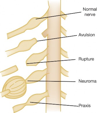 Erb-Duchenne Brachial Plexus Birth Palsy: Clinical Diagnosis & Imaging in Newborns