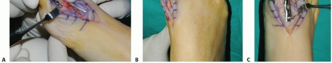 Illustration 24 for MTP Joint Arthrodesis: The Key to Optimal Toe Positioning