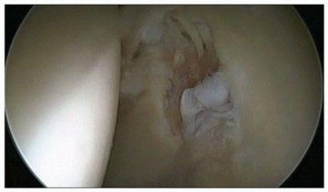 Illustration 6 for Hip Pain Relief: Arthroscopy for Nonstructural Pathology