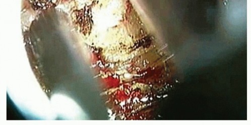 End Lumbar Spinal Stenosis Pain with Minimally Invasive Laminectomy