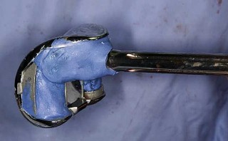 Illustration 17 for Understand Augments: The Role of Metal Augments in Arthroplasty