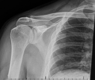 Illustration 37 for Right Shoulder Pain? Avoid This Common X-ray Mistake.