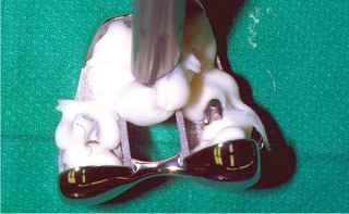 Illustration 30 for The Principles of Revision TKR: Avoid Pitfalls, Ensure Success