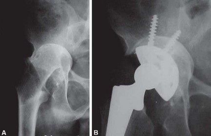 Illustration 32 for Total Hip Replacement for Protrusio: Restore Your Hip Function