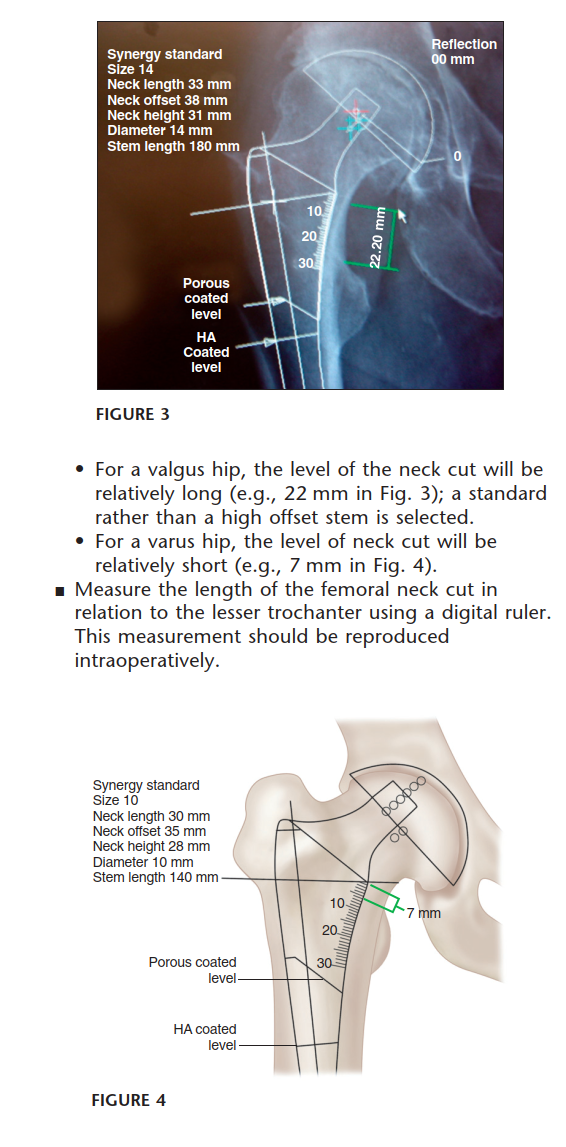 Illustration 4 for Templating for Primary THA: Optimize Outcomes & Avoid Pitfalls