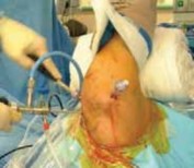 Illustration 15 for Regain Stability: Anterior Shoulder Instability Arthroscopic Fix