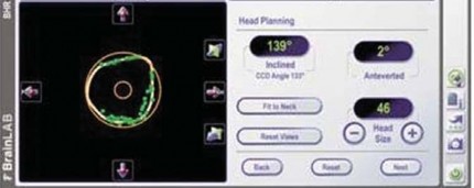 Illustration 38 for Minimizing Risks: Computer Navigation in Hip Resurfacing Arthroplasty