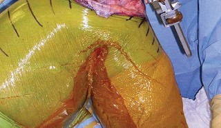 Illustration 17 for Optimize Tibial Component Alignment: Techniques for TKA Success