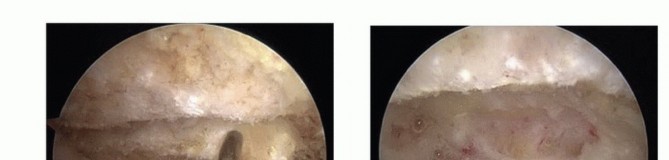 Illustration 13 for Find Relief: Arthroscopic Subacromial Decompression for Impingement