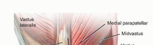 Illustration 6 for Achieve Lasting Pain Relief with Cemented Total Knee Arthroplasty