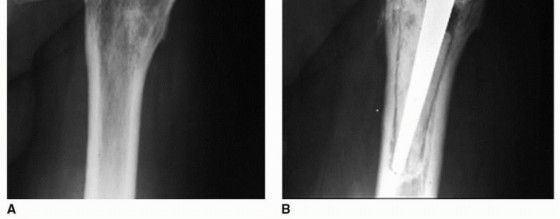 Illustration 2 for Overcoming Proximal Femoral Deformity in THA: Key Strategies