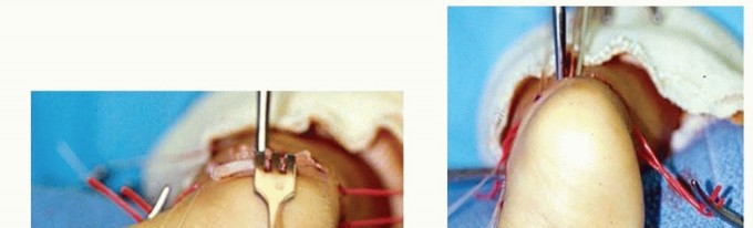 Illustration 15 for Resistant Clubfoot Solved: Posteromedial and Posterolateral Release