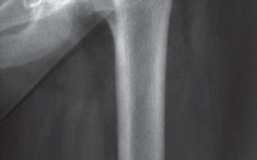 Illustration 41 for Successful Total Hip Replacement in Developmental Dysplasia