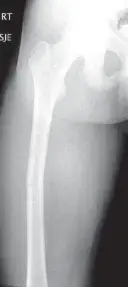 صورة توضيحية لـ كسور عظم الفخذ لدى الأطفال والكبار: دليل شامل لخيارات العلاج والتعافي مع الأستاذ الدكتور محمد هطيف