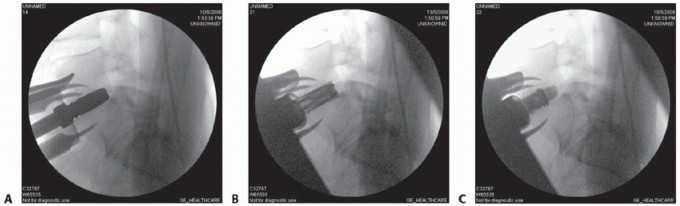 Illustration 10 for Anterior Lumbar Interbody: Fusion, Disc Replacement & Pain Relief