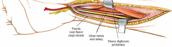Illustration 46 for Volar Approach: Optimal Exposure for the Volar aspect of the Distal Radius