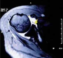 Illustration 8 for Arthroscopic Subscapularis Repair: The lo iky brady Method for Stability