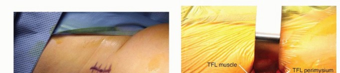 Illustration 12 for Anterior FAI Relief: Mini-Open Anterior Approach Explained