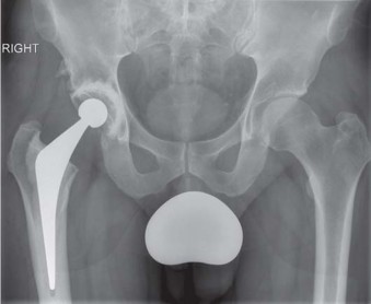 Illustration 13 for Navigating Early THA for Fractures of the Acetabulum