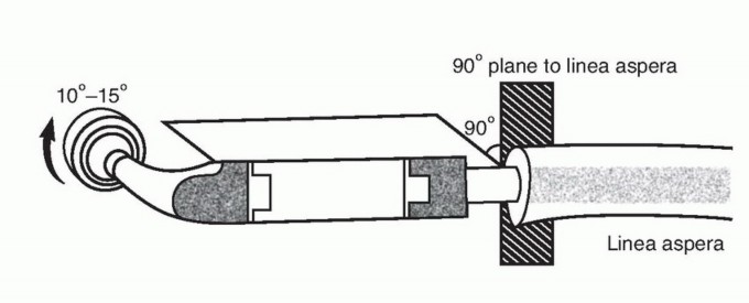 Illustration 40 for Beyond Amputation: Total Femur Resection with Endoprosthetics